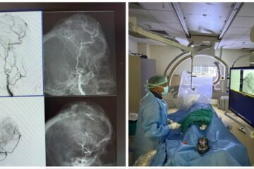 अत्याधुनिक प्रीऑपरेटिव ट्यूमर एम्बोलाइजेशन से जटिल स्कल मेनिंजियोमा का सफल उपचार