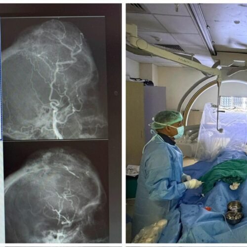 अत्याधुनिक प्रीऑपरेटिव ट्यूमर एम्बोलाइजेशन से जटिल स्कल मेनिंजियोमा का सफल उपचार